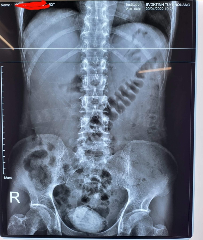Phim chụp X-quang dị vật trong bụng bệnh nhân. Ảnh: Bệnh viện cung cấp