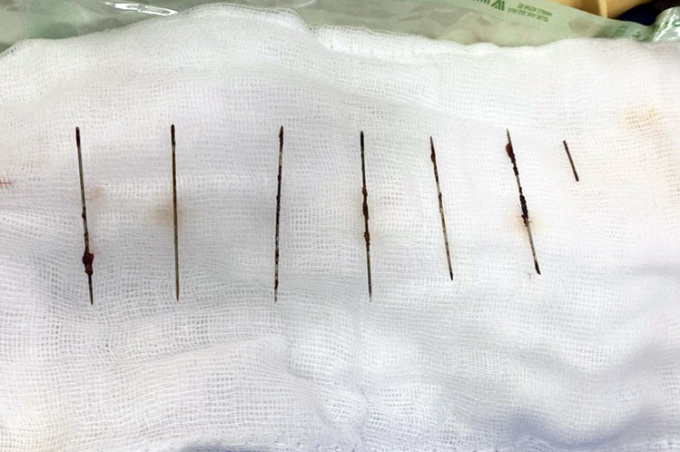 Bảy cây kim được lấy ra từ lồng ngực bệnh nhân. Ảnh: Bệnh viện cung cấp