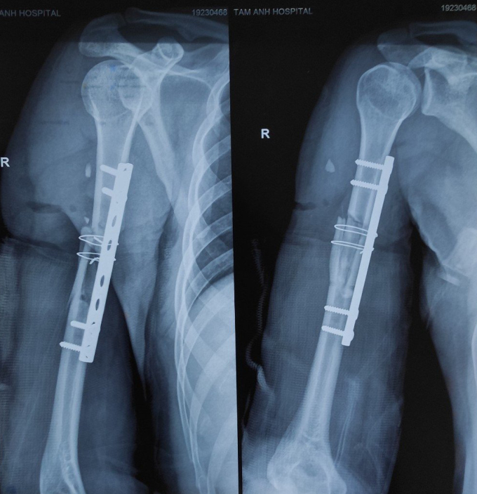 Phim chụp X-quang phần xương cánh tay bị gãy rời đã được nẹp bắt vít của bệnh nhân Đức Ảnh: Nhân vật cung cấp