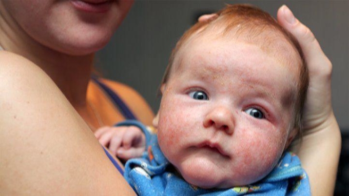 Trẻ bị eczema phổ biến ở trẻ, dễ điều trị tại nhà. Ảnh: Everdayhealth