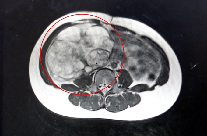 Hình ảnh chụp cắt lớp khối u buồng trứng kích thước lớn ở bé gái 12 tuổi. Ảnh: Bệnh viện cung cấp