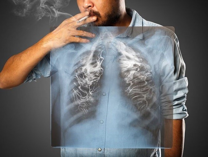 Các triệu chứng của ung thư phổi giống với nhiều bệnh lý khác như Covid-19. Ảnh: Shutterstock