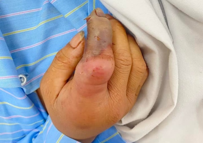 Vết thương ở ngón tay của bệnh nhân sau khi bị rắn cắn. Ảnh: Bác sĩ cung cấp