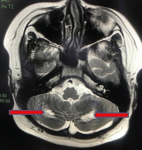 Hình ảnh cộng hưởng từ (MRI) não cho thấy tổn thương chất trắng vùng tiểu não hai bên gây hiện tượng rối loạn phối hợp vận động, loạng choạng... Ảnh: Bác sĩ cung cấp