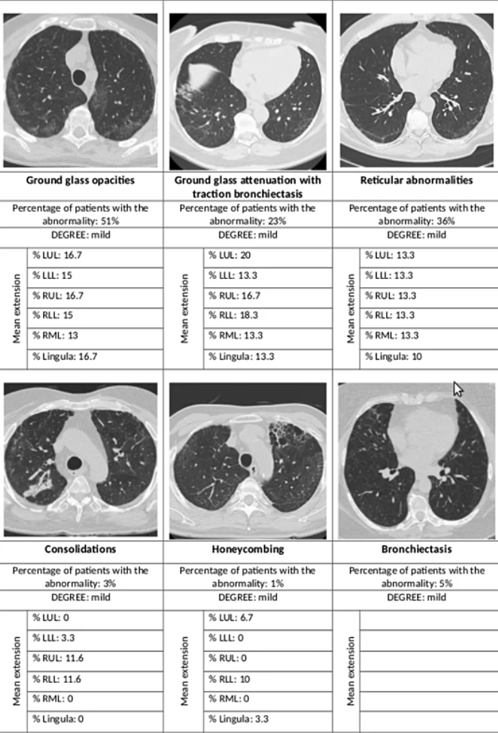 Hình ảnh phổi bệnh nhân một năm sau khi khỏi Coivd-19. Ảnh: News Medical Life Science