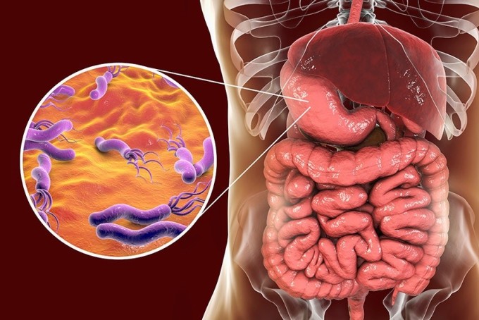 Nhiều trường hợp viêm loét dạ dày do vi khuẩn H. pylori gây ra. Ảnh: Shutterstock