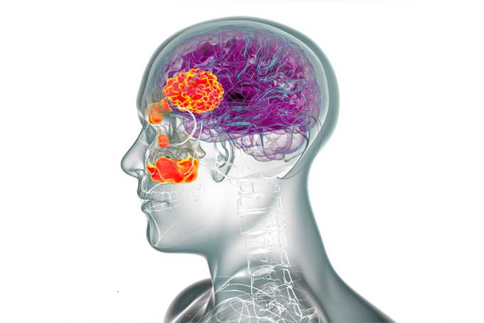 Biến chứng viêm xoang có thể ảnh hưởng đến não. Ảnh: Shutterstock