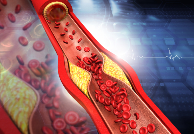 Cholesterol chỉ có hại khi nồng độ của chúng trong máu tăng cao, gây các mảng xơ vữa trong lòng mạch. Ảnh: Shutterstock