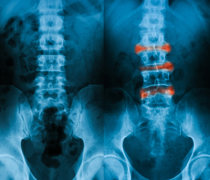 Viêm cột sống dính khớp nếu không được điều trị có thể dẫn đến tàn phế. Ảnh: Shutterstock