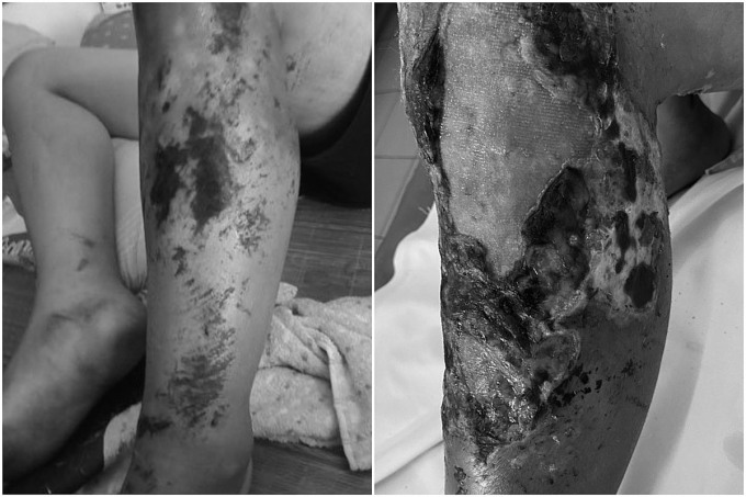 Hình ảnh vết thương bệnh nhân trước và sau khi đắp thuốc nam. Ảnh: Bệnh viện cung cấp
