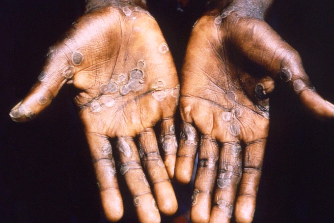Lòng bàn tay của người bị đậu mùa khỉ. Ảnh: CDC