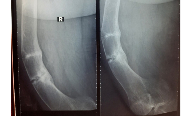 Hình ảnh xương chân phải gãy, biến dạng trước phẫu thuật. Ảnh: Bệnh viện cung cấp