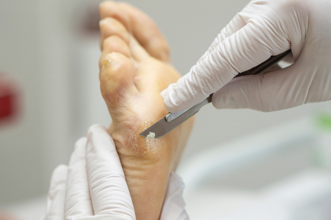 Chai chân có thể điều trị đơn giản Ảnh: Shutterstock