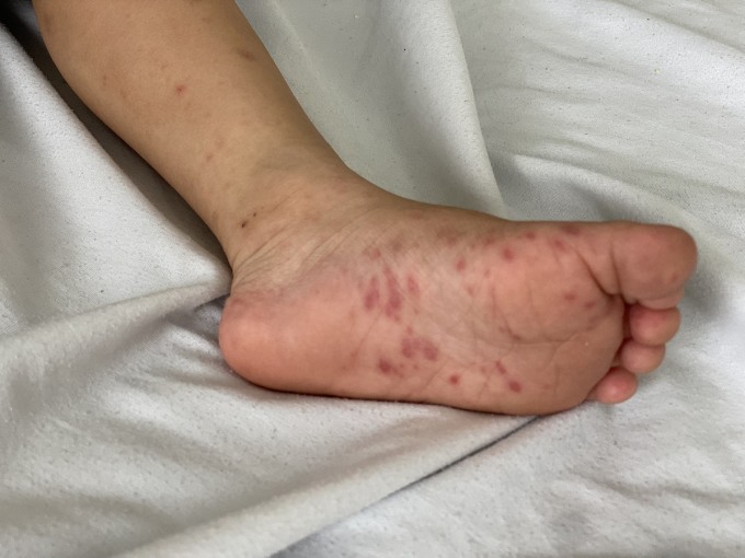 Bàn chân của bệnh nhi mắc tay chân miệng, điều trị tại Bệnh viện Bệnh nhiệt đới Trung ương ngày 25/5. Ảnh: Kiều Trang