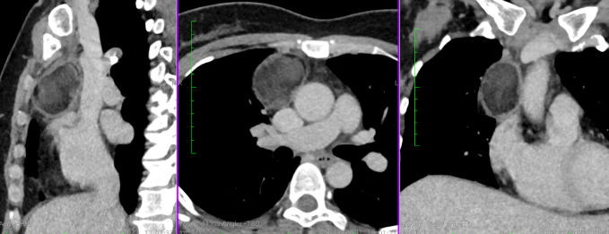 Hình ảnh khối u quái trên phim chụp CT phổi. Ảnh: Bệnh viện Đa khoa Tâm Anh