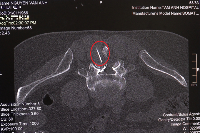 Hình ảnh mũi tiêm (khoanh đỏ) vào khoang ngoài màng cứng của bệnh nhân Văn Anh. Ảnh: BVĐK Tâm Anh