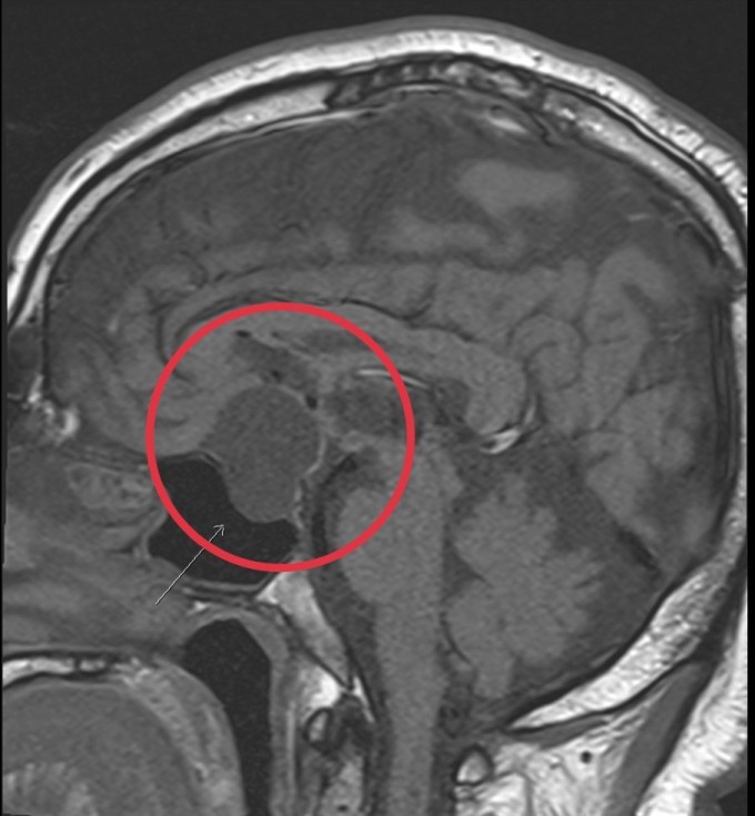 Hình ảnh chụp cộng hưởng từ cho thấy có khối u nhỏ bằng hạt đậu ở tuyến yên của người bệnh. Ảnh: BVĐK Tâm Anh