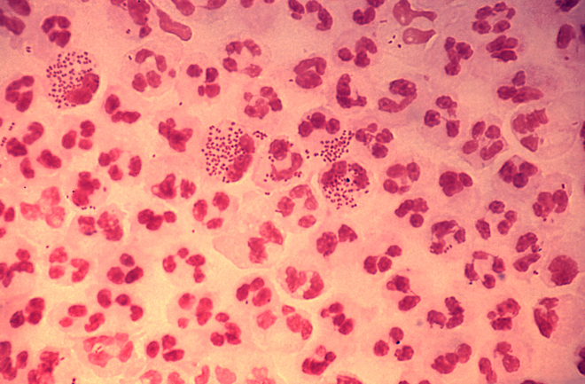 Vi khuẩn Neisseria gonorrhoeae gây ra bệnh lậu. Ảnh:Alamy