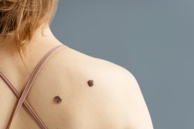 Nhiều nốt ruồi trên da có thể có khả năng mắc ung thư vú. Ảnh: Freepik.