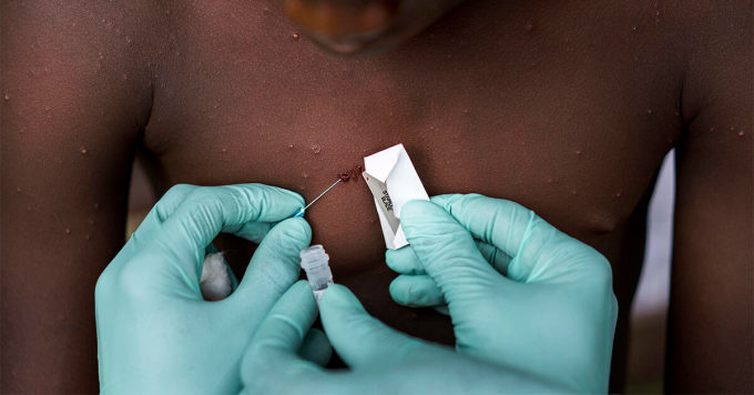 Một bé trai nghi nhiễm đậu mùa khỉ ở Manfuette, Congo được bác sĩ lấy mẫu xét nghiệm. Ảnh: Washington Post