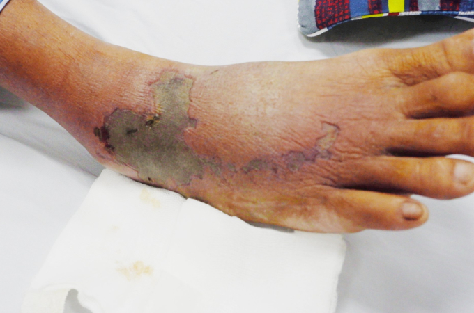 Vết thương rắn cắn trên chân bệnh nhân khi đã được chữa lành. Ảnh: Bệnh viện cung cấp