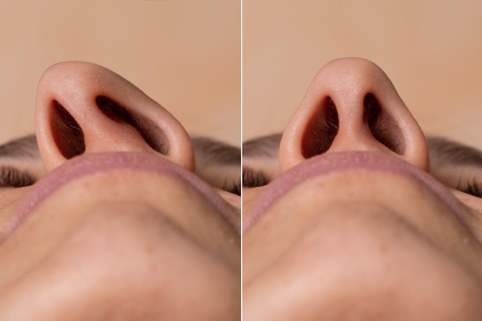 Vẹo vách ngăn mũi có thể khiến bệnh viêm xoang, viêm mũi họng tiến triển nặng. Ảnh: Shutterstock
