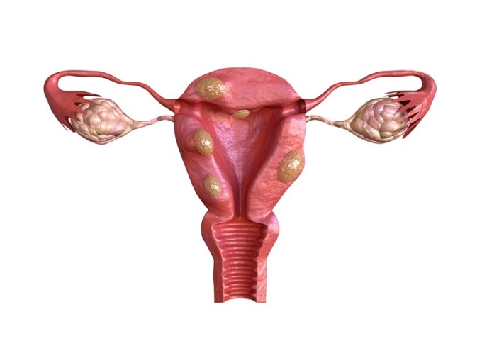 U xơ tử cung là khối u thường gặp ở phụ nữ trong độ tuổi sinh sản. Ảnh: Shutterstock