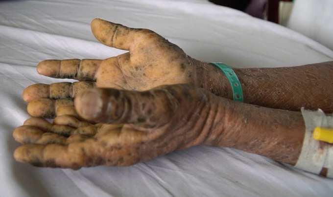 Bàn tay xù xì, bong tróc của một người bệnh bị nhiễm độc sau thời gian dài uống nhiều loại thuốc đông y để tăng cường sinh lực và chữa viêm gan. Ảnh: An Mỹ