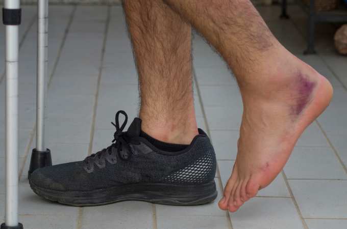 Chấn thương dây chằng khớp cổ chân có thể gặp ở cả vận động viên chuyên nghiệp. Ảnh: Shutterstock