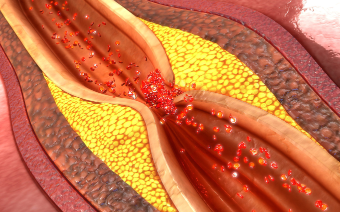 Bệnh lý mạch vành là một trong các yếu tố nguy cơ của nhịp nhanh thất. Ảnh: Shutterstock