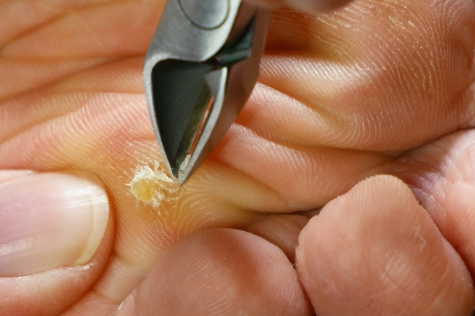 Tự loại bỏ vết chai có thể dẫn loét và nhiễm trùng bàn chân. Ảnh: Shutterstock