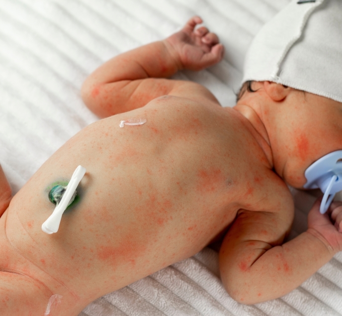 Trẻ sơ sinh viêm da do được ủ ấm kỹ trong mùa hè. Ảnh: Shutterstock