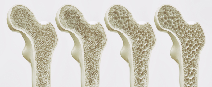 Loãng xương là một trong những nguyên nhân chính dẫn đến còng lưng ở người cao tuổi. Ảnh: Shutterstock