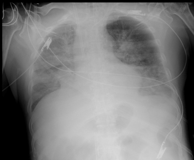 Hình ảnh Xquang phổi bệnh nhân ngày 30/5. Ảnh: Bệnh viện cung cấp