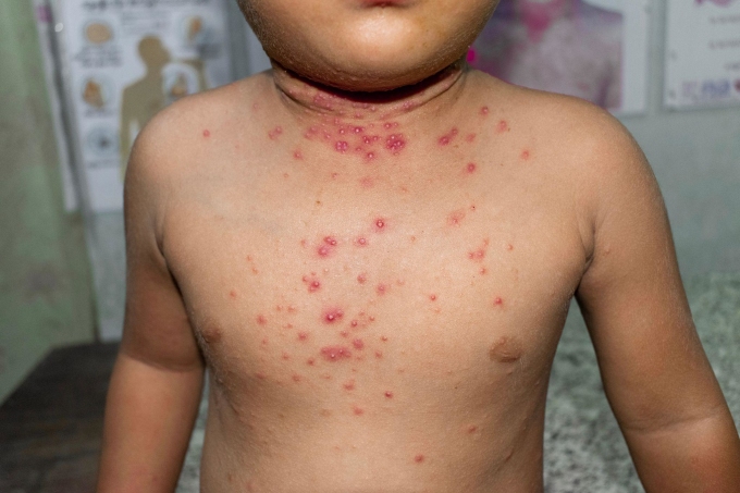 Cần cảnh giác bệnh đậu mùa khỉ ở trẻ em vì có thể để lại biến chứng nặng. Ảnh: Shutterstock
