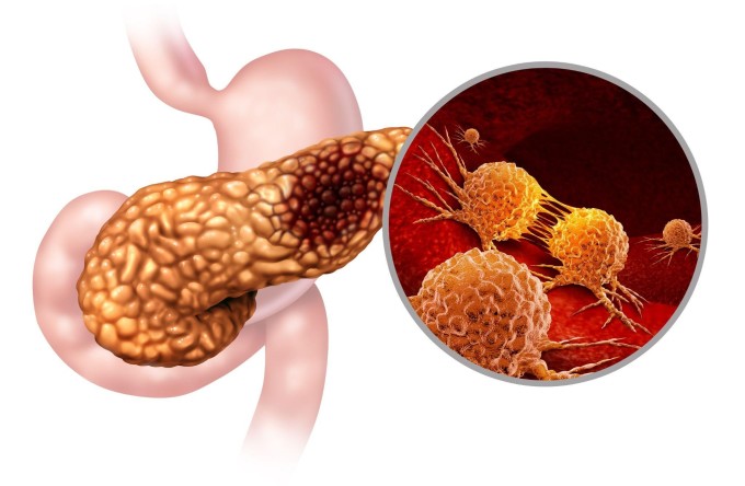 Các tế bào tụy bị tổn thương có thể dẫn đến hoại tử một phần hoặc toàn bộ tụy. Ảnh: Shutterstock