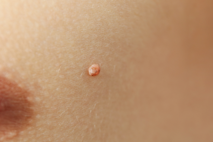 Nốt ruồi trên da có sự thay đổi bất thường là một trong những dấu hiệu cảnh báo ung thư. Ảnh: Freepik