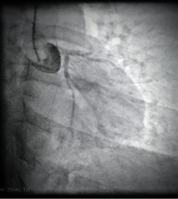 Hình ảnh mạch vành của người bệnh bị tắc. Ảnh: Bệnh viện cung cấp