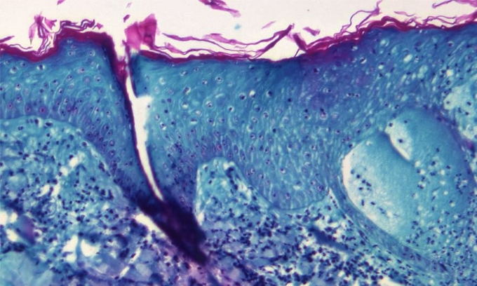Hình ảnh hiển vi mô da của một con khỉ nhiễm virus đậu mùa khỉ. Ảnh: CDC