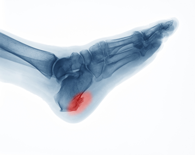 Gai gót chân ảnh hưởng khả năng đi lại của người bệnh. Ảnh: Shutterstock