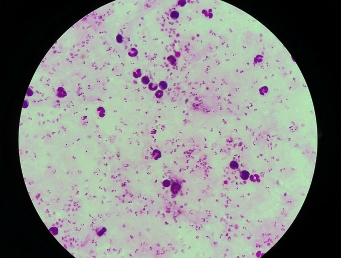 Hình ảnh ký sinh trùng sốt rét mật độ cao trong máu nữ bệnh nhân, với các chấm màu hồng tím là ký sinh trùng. Ảnh: Bác sĩ cung cấp