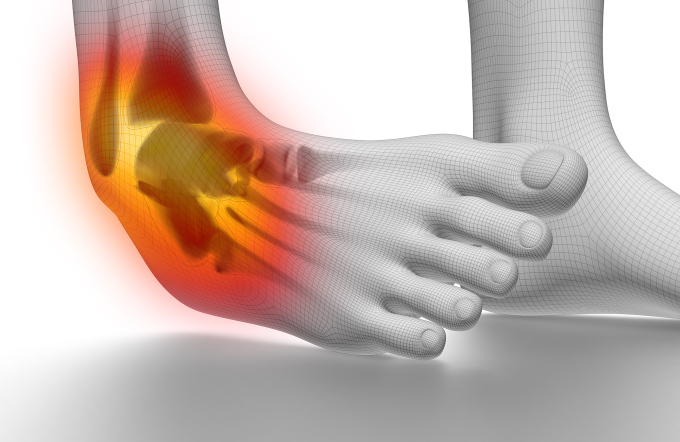 Chấn thương dây chằng bên ngoài khớp cổ chân có thể trở thành mạn tính nếu không được điều trị đúng cách. Ảnh: Shutterstock