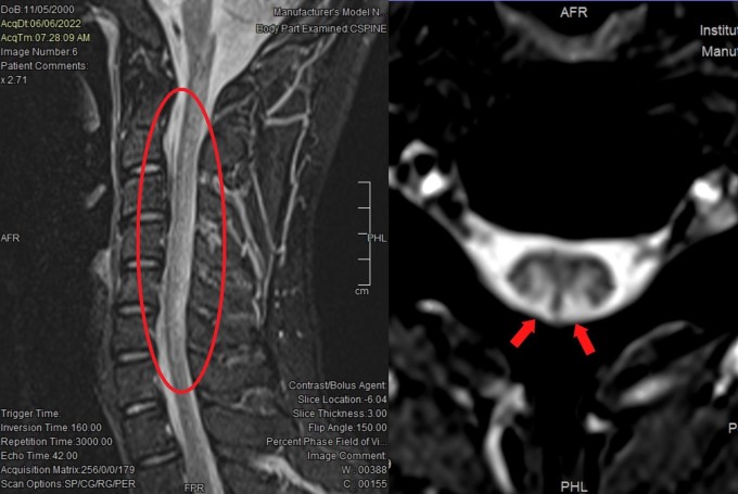 Hình ảnh tổn thương tủy cổ trên phim chụp MRI gợi ý ngộ độc N2O. Ảnh: Bệnh viện cung cấp.