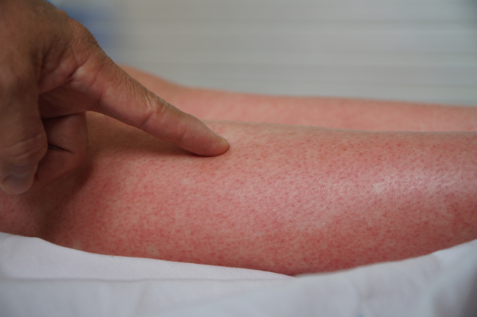 Những nốt tụ máu dày đặc trên chân một nữ bệnh nhân đang điều trị sốt xuất huyết tại Bệnh viện Bệnh Nhiệt đới TP HCM. Chị cho biết, trước khi mắc bệnh, chị không có thói quen ngủ trong màn (mùng), dù trong phòng có nhiều muỗi và trong khu trọ mới có người mắc sốt xuất huyết. Ảnh: Thư Anh