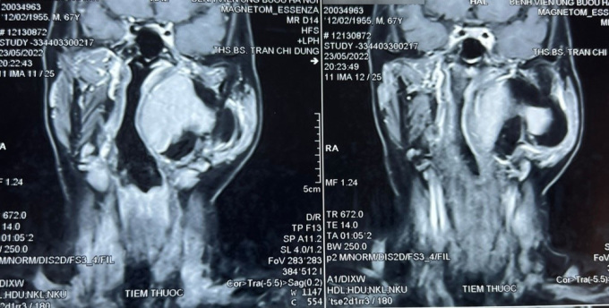 Hình ảnh chụp cộng hưởng từ khối u khoảng bên họng của bệnh nhân. Ảnh: Bệnh viện cung cấp