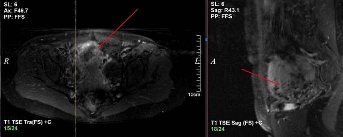 Hình ảnh siêu âm khối chửa trứng của bệnh nhân. Ảnh: Bệnh viện cung cấp