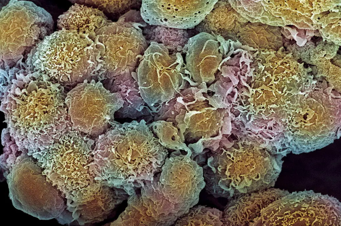 Các tế bào ung thư vú của một bệnh nhân. Ảnh: Science Source