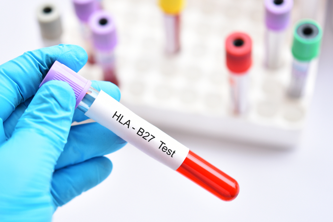 Xét nghiệm HLA - B27 là một trong những phương pháp tối ưu để chẩn đoán viêm khớp phản ứng. Ảnh: Shutterstock