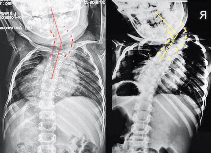Hình ảnh chụp Xquang bé năm 2019 (bên trái) và 2022 (bên phải). Ảnh: Bệnh viện cung cấp
