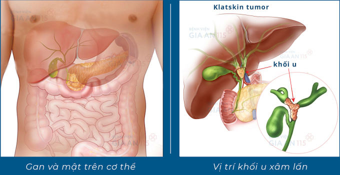 Hình ảnh minh hoạ ung thư đường mật vùng rốn gan, còn gọi u Klatskin. Ảnh: Bệnh viện cung cấp